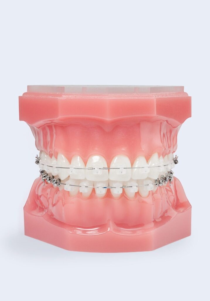 Model of teeth with Damon clear braces on top and bottom teeth for Greater Northwest Orthodontics website